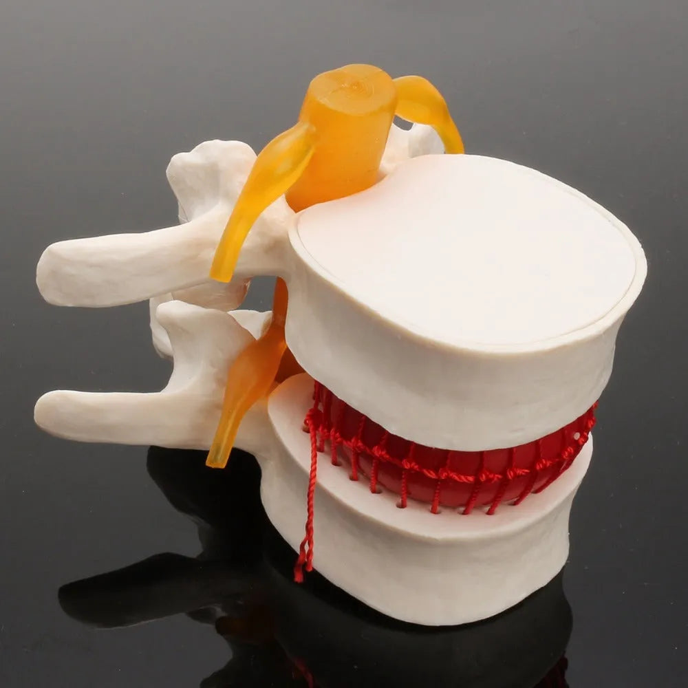 White PVC medical demonstration model of lumbar intervertebral disc herniation