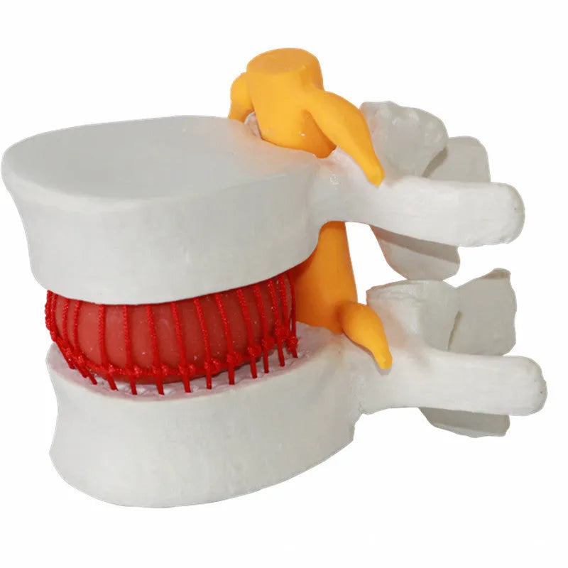 White PVC medical demonstration model of lumbar intervertebral disc herniation