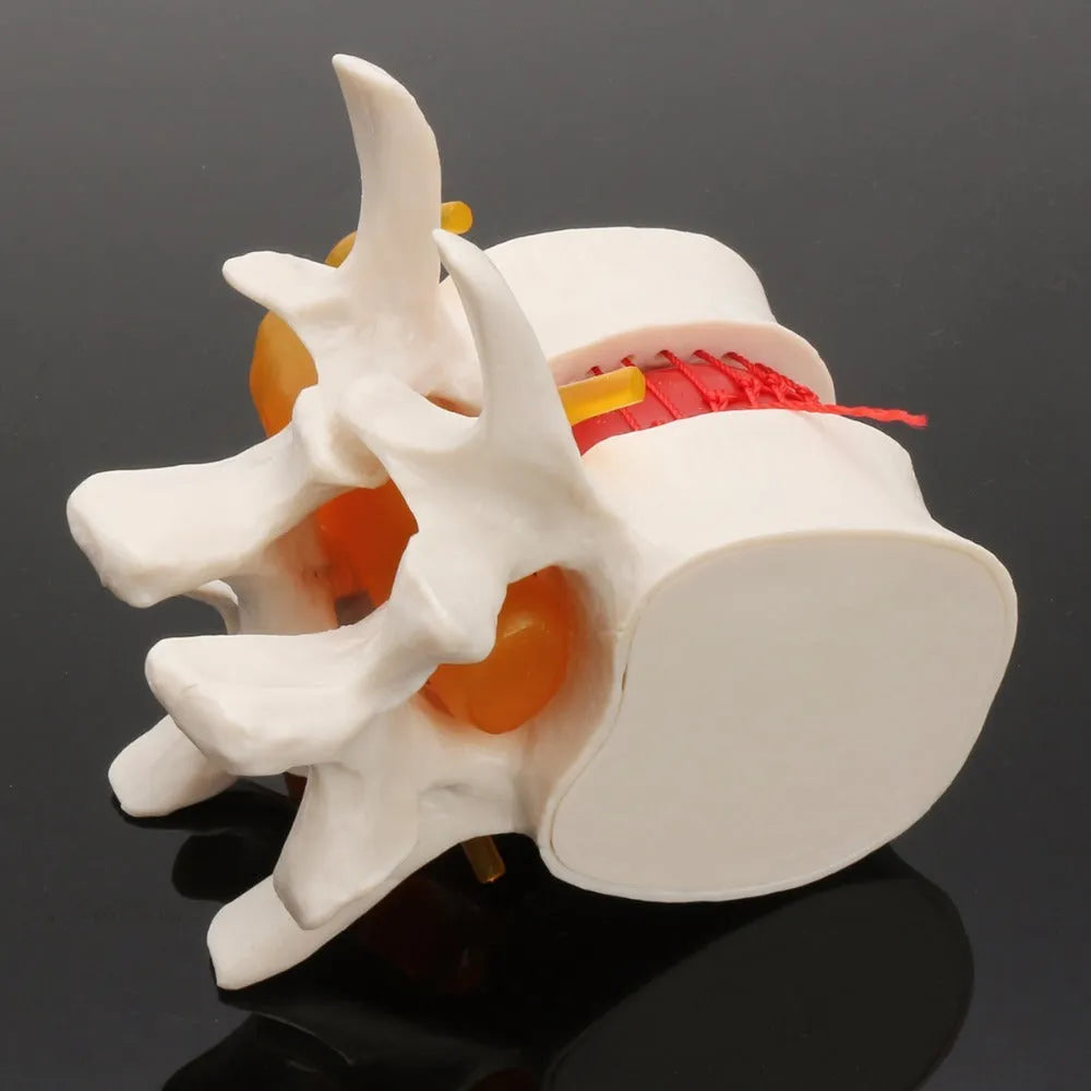 White PVC medical demonstration model of lumbar intervertebral disc herniation