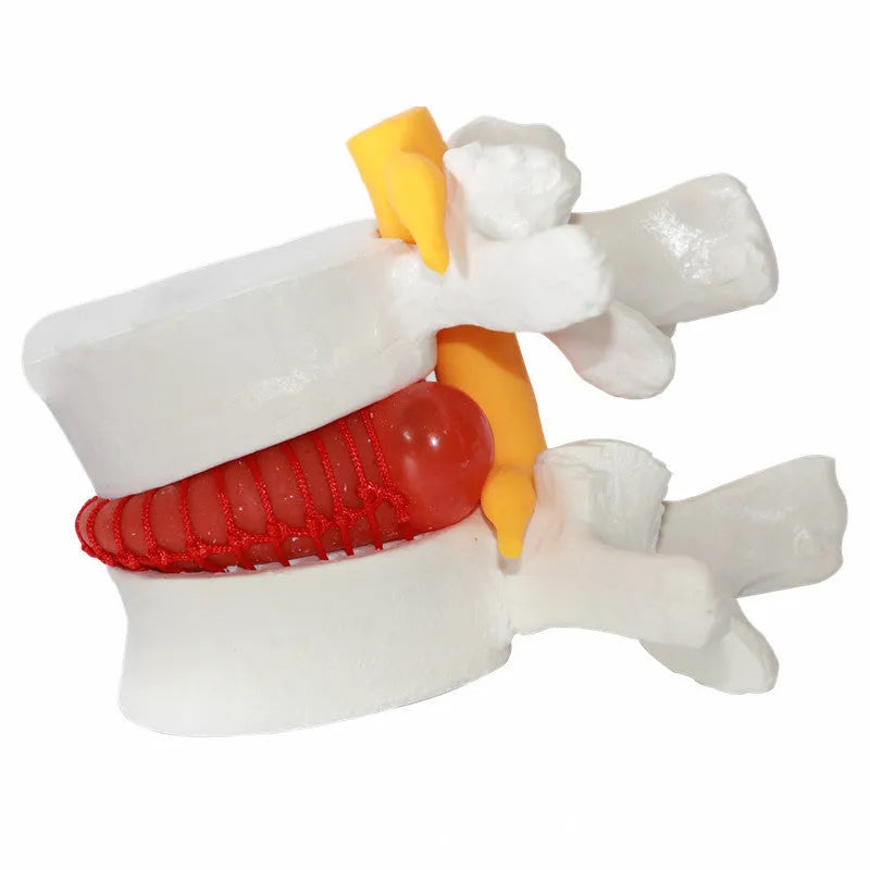 White PVC medical demonstration model of lumbar intervertebral disc herniation