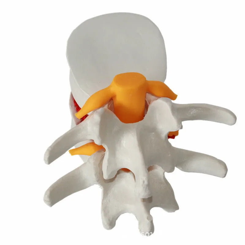 White PVC medical demonstration model of lumbar intervertebral disc herniation