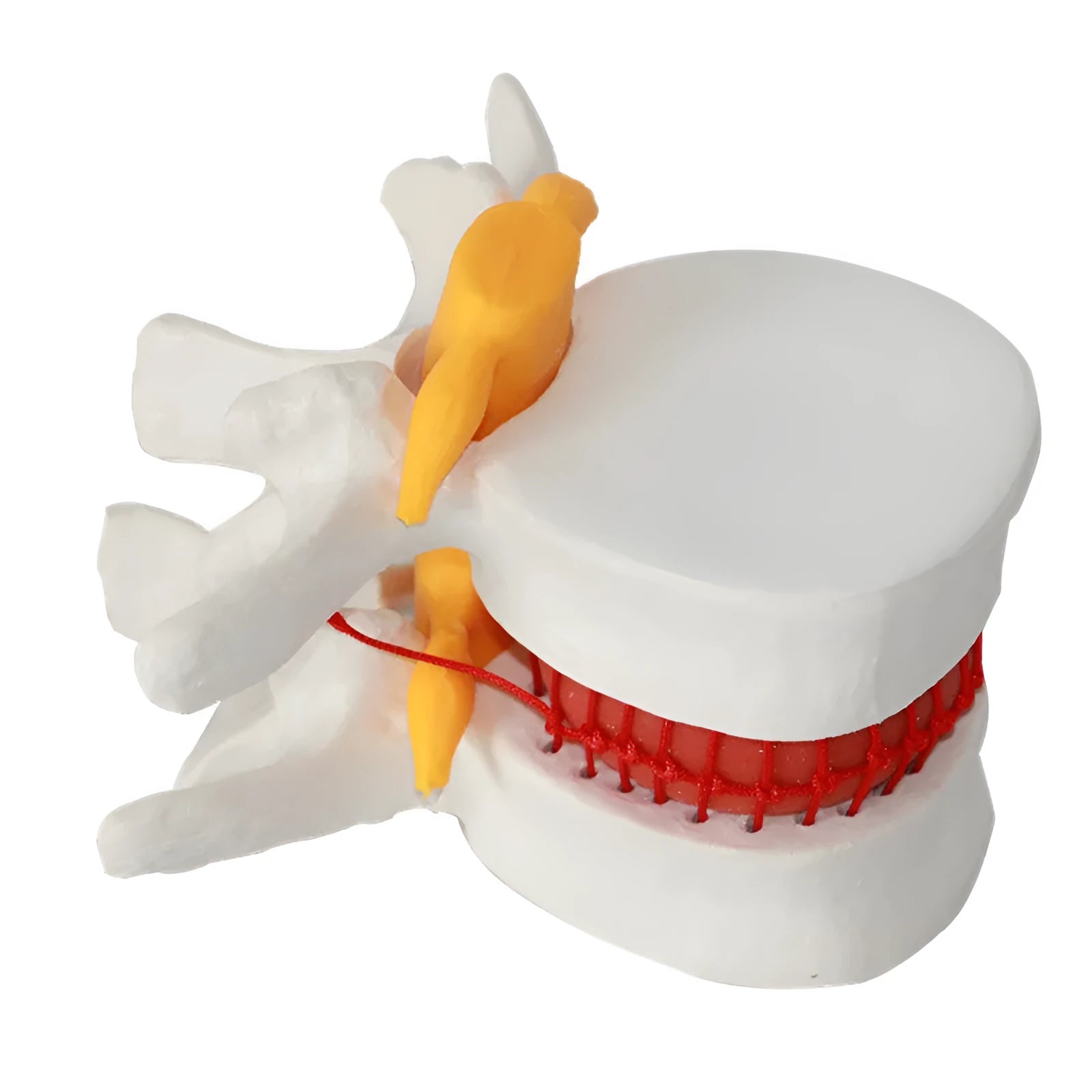 White PVC medical demonstration model of lumbar intervertebral disc herniation