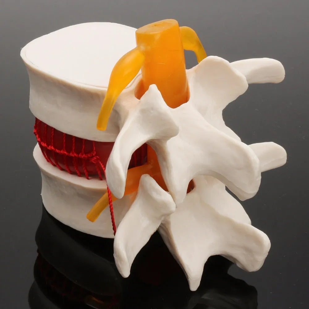 White PVC medical demonstration model of lumbar intervertebral disc herniation