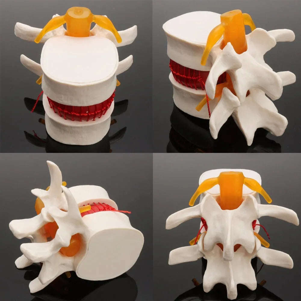 White PVC medical demonstration model of lumbar intervertebral disc herniation